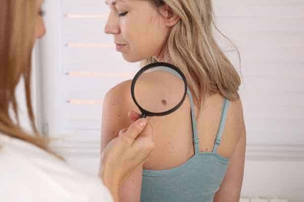 What Are Traditional Skin Lesion Removal Methods Aylesbury?
