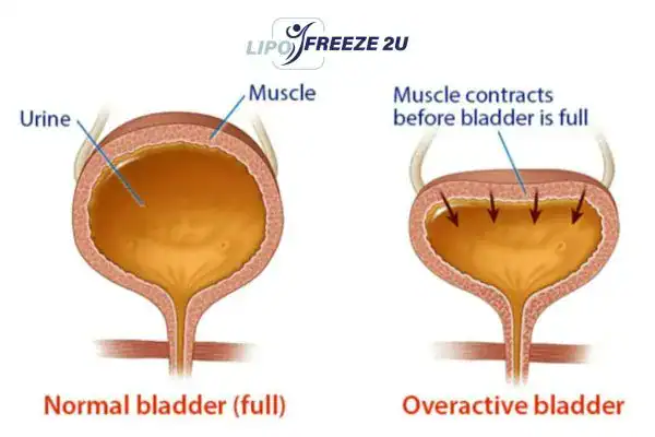 diagram of overactive bladder treatment Aylesbury