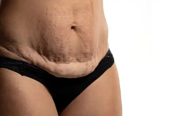 loose skin after weight loss injections Aylesbury