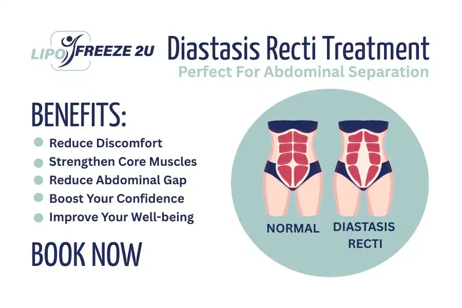How Long Will It Take to See Improvements in Diastasis Recti Aylesbury