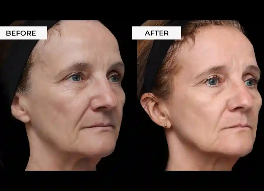 How Many RF Microneedling Sessions Will You Need to See a Difference Aylesbury?
