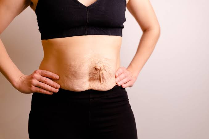 Is Surgery Really the Only Way to Repair Diastasis Recti Aylesbury?