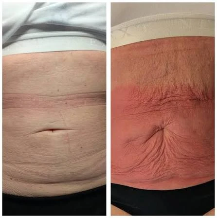How Does RF Microneedling Improve Crepey, Thin and Uneven Skin Texture Aylesbury?
