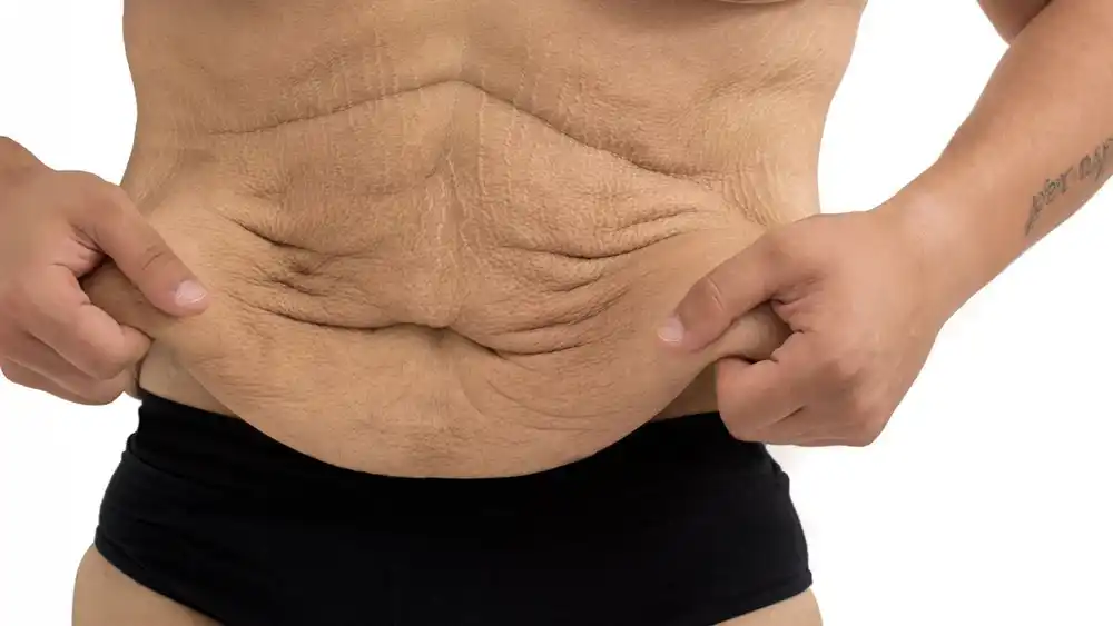 Why Does Weight Loss Medication Leave Some People With Loose or Sagging Skin Aylesbury?